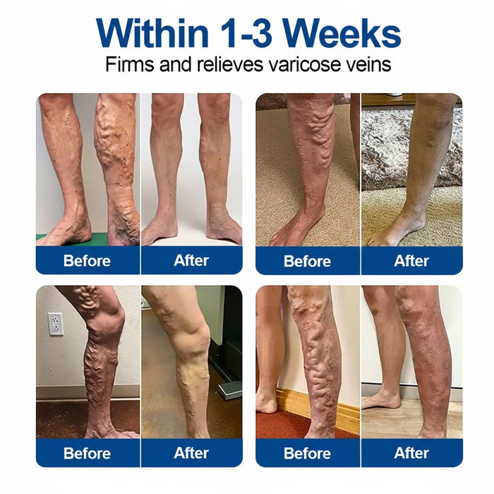 🇺🇸 🥰GFOUK® VeinEase Microneedle Care Patch⚡Instant Relief, Long-Term Results